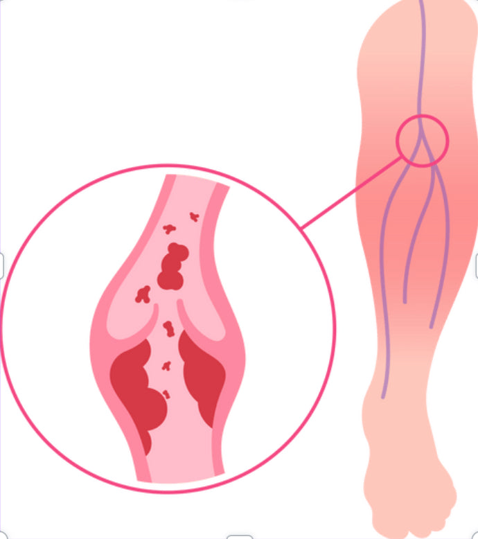 Thrombose veineuse profonde